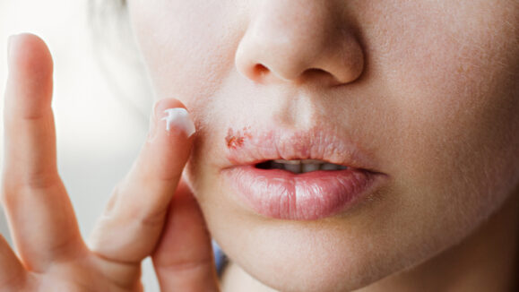 Part,Of,A,Young,Woman's,Face,With,A,Virus,Herpes