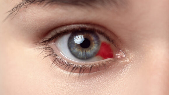 Bloodshot,Eye.,Woman,With,Burst,Blood,Vessel,In,Eye.,Very