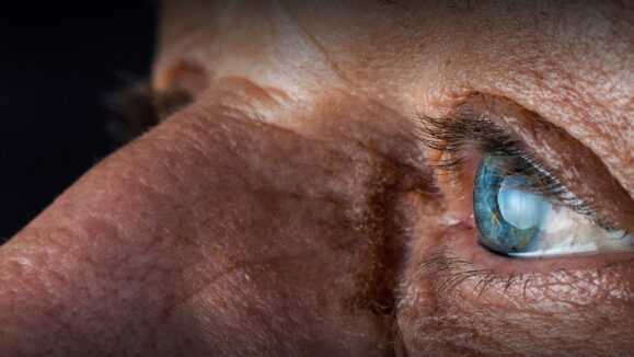 Complications in Cataract Surgery at APACRS 2024 02