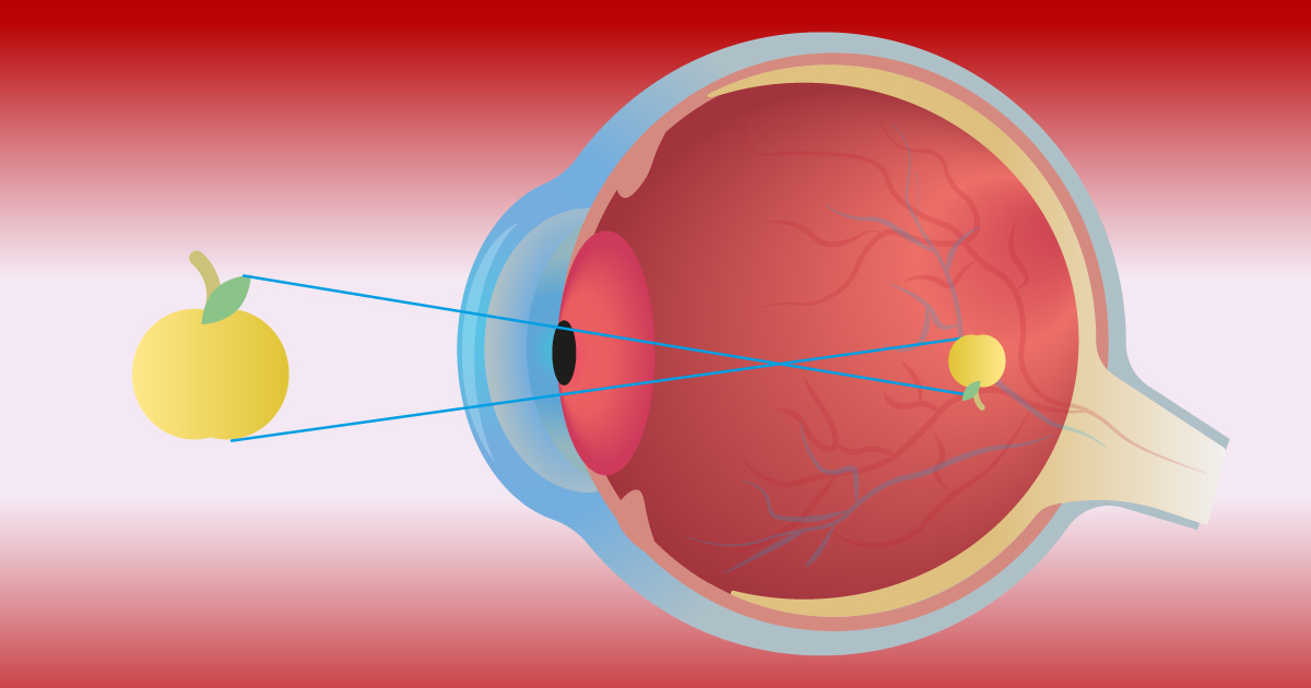 REFRACTIVE ERRORS 02